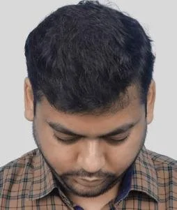 Hair Transplant After Results - Best Hair Transplant Clinic in Delhi